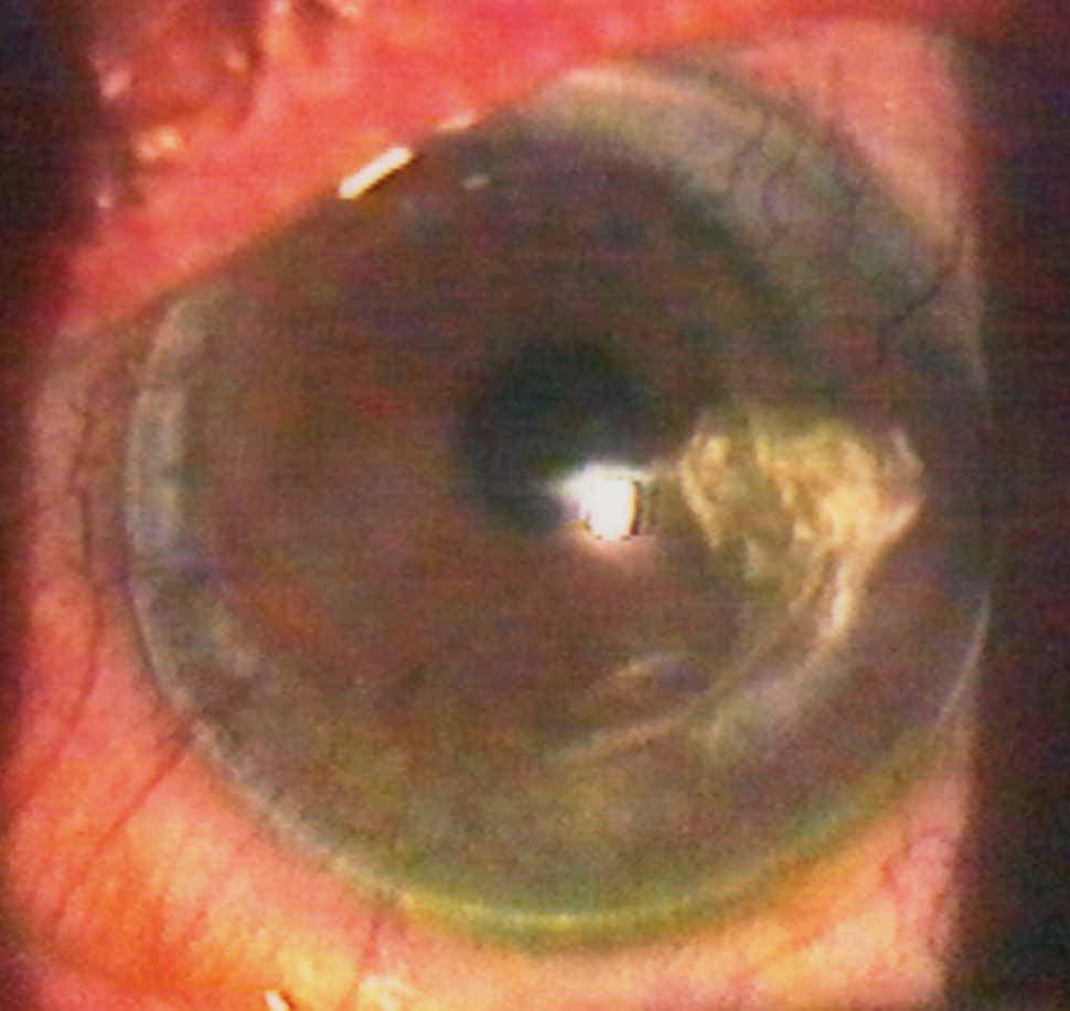 Penetrating Keratoplasty : C l i n i c a l c a s e s - Thread relaxation - After thread removal (only in