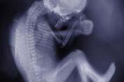 Fetal Radiation Risk