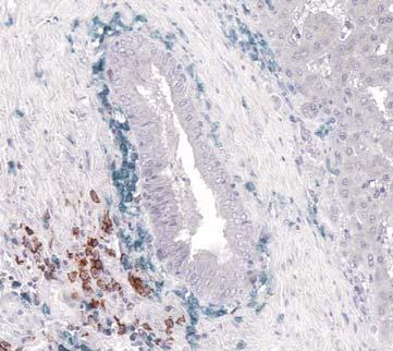 Figure 42 CD24-CD38+ B cells were located around liver bile ducts and along the fibrotic tracts,