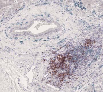 Triple IHC staining to locate CD24-CD38- (white arrows brown cells) and CD24-CD38+ B cells (black