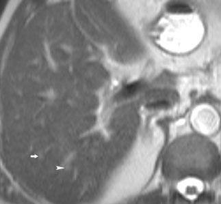 Liver Lesion detection: liver metastases T2-weighted b=20 s/mm 2 -