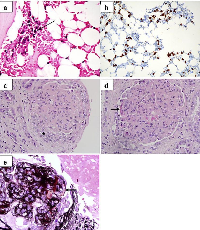 10 Fig. 1. Bone marrow (a, b) and kidney (c e) biopsies, light microscopy. a In situ hybridization for kappa light chain, with a positive signal indicated by blue staining (arrow).