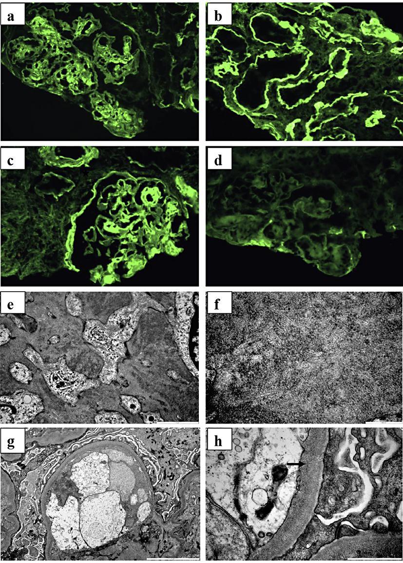 11 Fig. 2. Kidney biopsy. a d immunofluorescence microscopy, e h electron microscopy. a IgG staining of glomerular mesangial regions and segmental glomerular capillary walls.