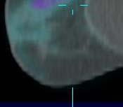 SPECT CT Towards Tomographic Breast