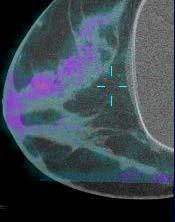Mammography Digital Tomosynthesis