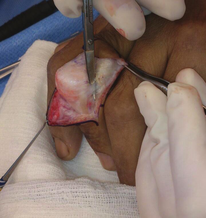 If the DIP joint does not flex, the retinacular (collateral) ligaments or proximal interphalangeal capsule are tight.