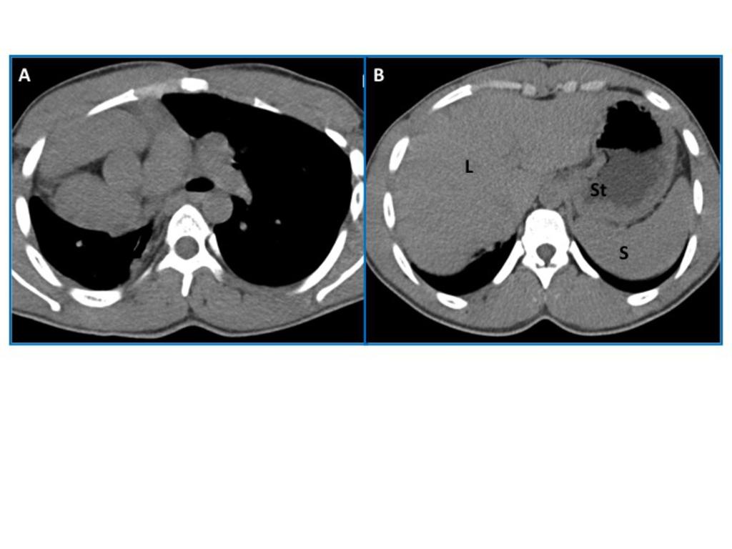 Fig. 2: Situs solitus with dextrocardia, in a 20-year-old-man, without cardiac anomalies besides dextrocardia.