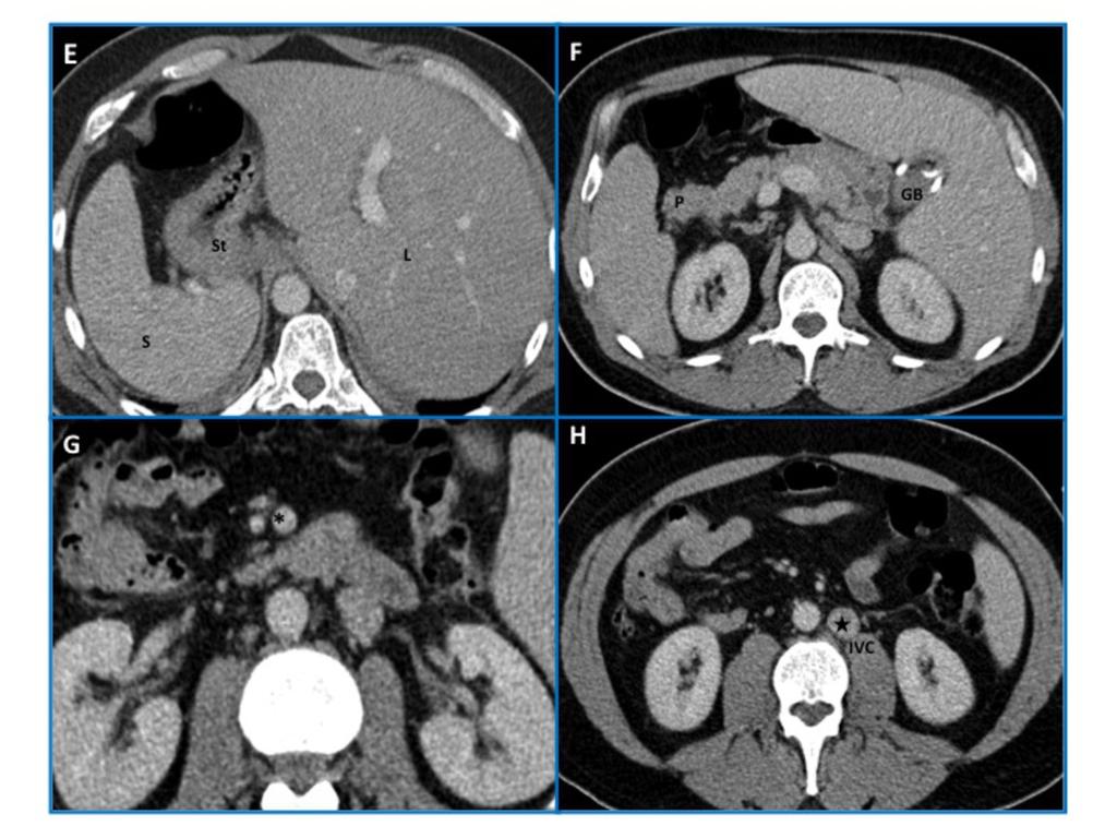 Fig. 6: Situs inversus in a 46-year-old man. Axial CT images of the abdomen demonstrate mirror-image location of the abdominal structures relative to situs solitus.
