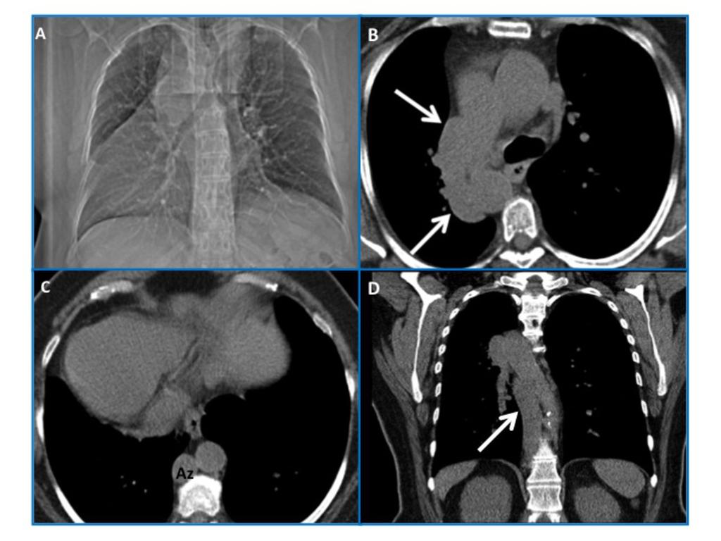 Fig. 8: Situs ambiguus with polysplenia and azygous continuation of IVC, in a 55-yearold woman with CHD. Chest CT scanogram shows dextrocardia and cardiomegaly (A).