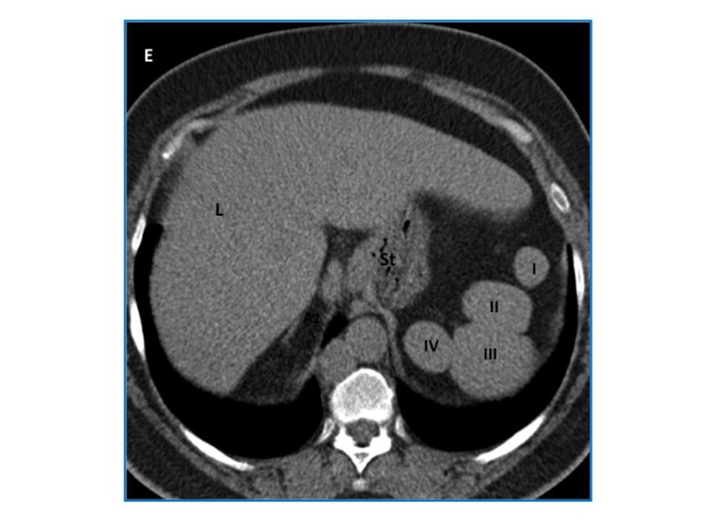 Fig. 9: Situs ambiguus with polysplenia and azygous continuation of IVC, in a 55-yearold woman with CHD. Unenhanced CT scan of upper abdomen reveals several small rounded spleens (I - IV) on the left.