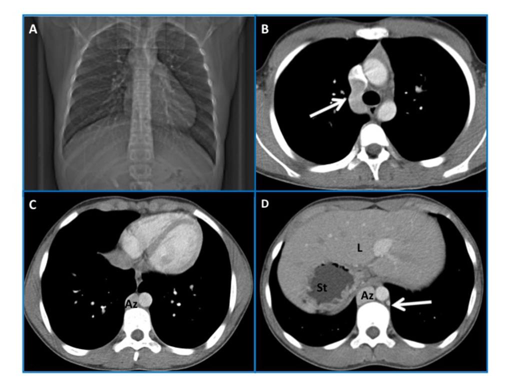Fig. 10: Situs ambiguus with polysplenia and azygous continuation of IVC, in a 15-yearold male patient. Chest CT scanogram shows levocardia and a midline liver (A).