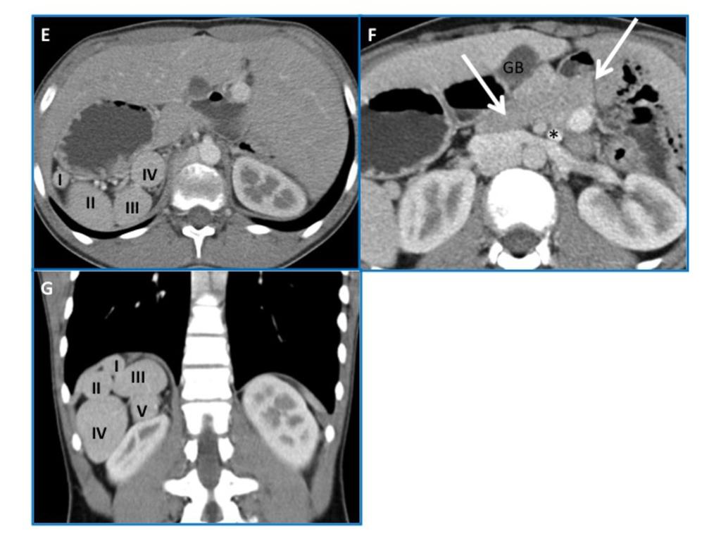 Fig. 11: Situs ambiguus with polysplenia and azygous continuation of IVC, in a 15-yearold male patient.