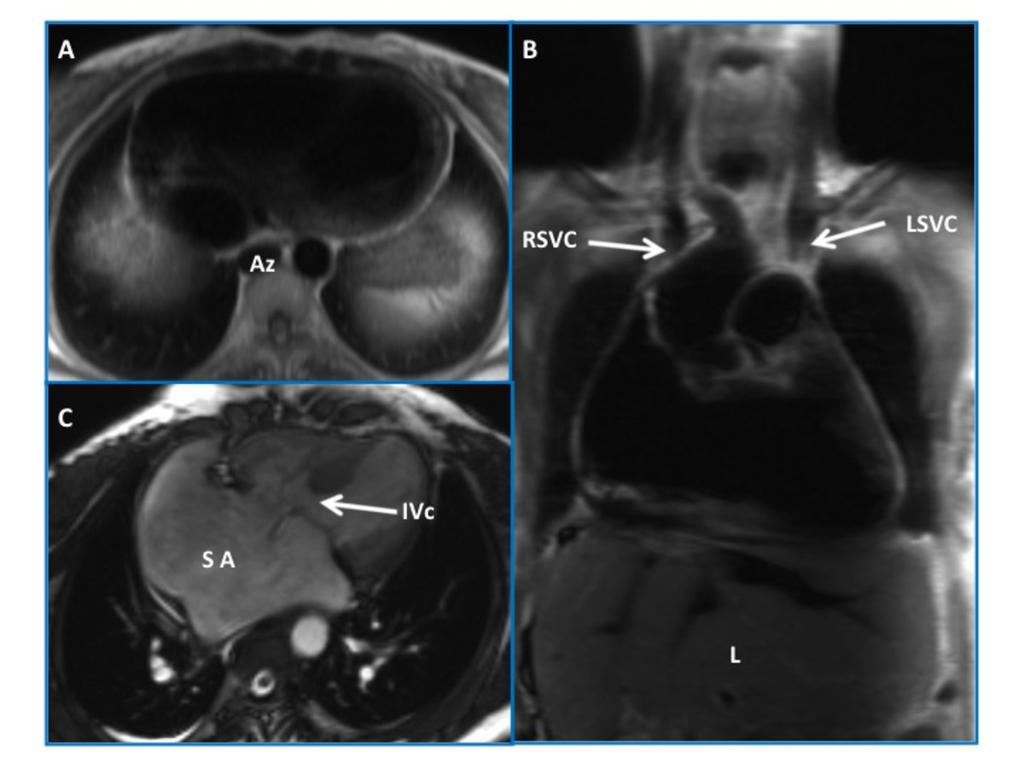Fig. 12: Situs ambiguus with polysplenia and azygous continuation of IVC in a 51-year-old woman with CHD. Axial MR image shows azygous (Az) continuation of IVC (A).