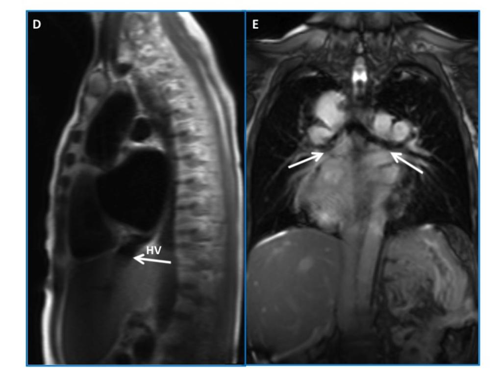 Fig. 13: Situs ambiguus with polysplenia and azygous continuation of IVC in a 51-yearold woman with CHD.