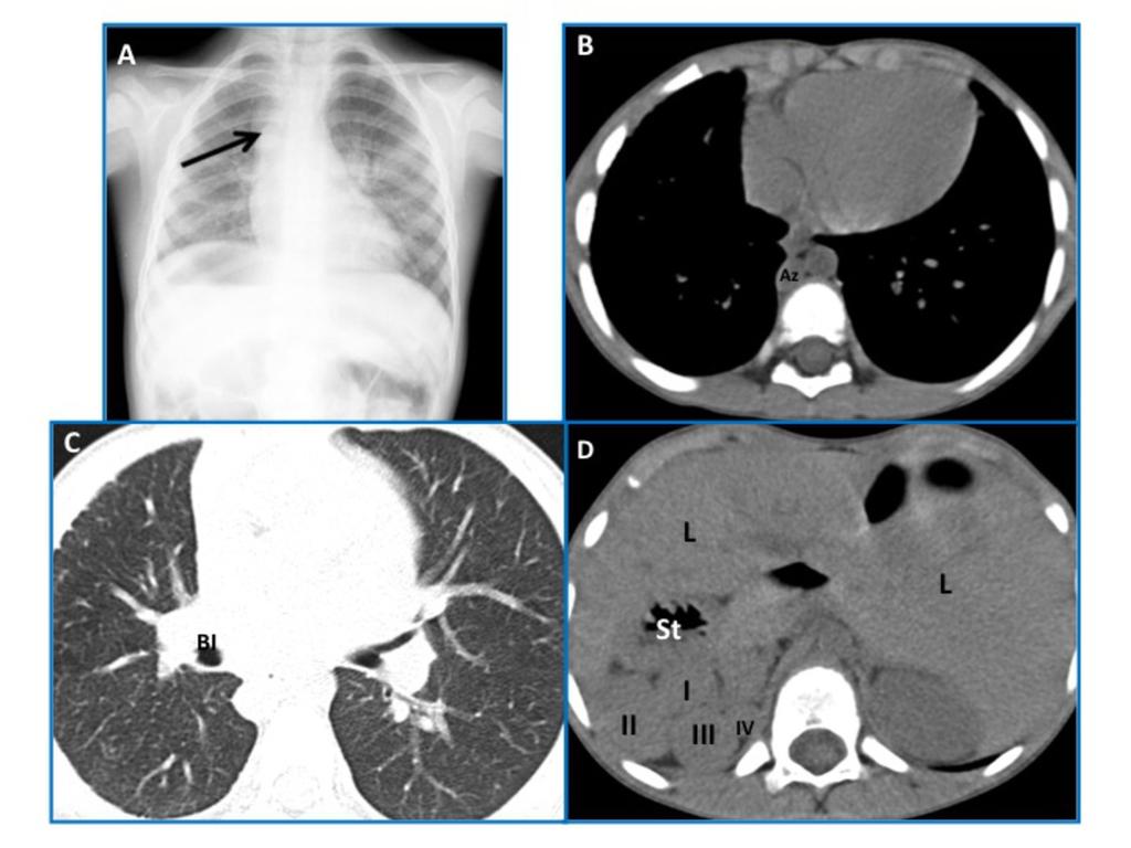 Fig. 19: Situs ambiguus with levocardia, polysplenia,azygous continuation of IVC and bowel malrotation, in a male child.