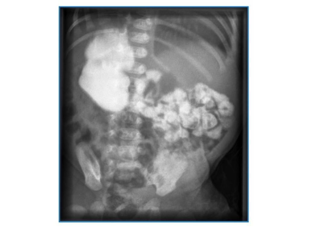 Fig. 20: Situs ambiguus with levocardia,polysplenia,azygous continuation of IVC and bowel malrotation, in a male child.