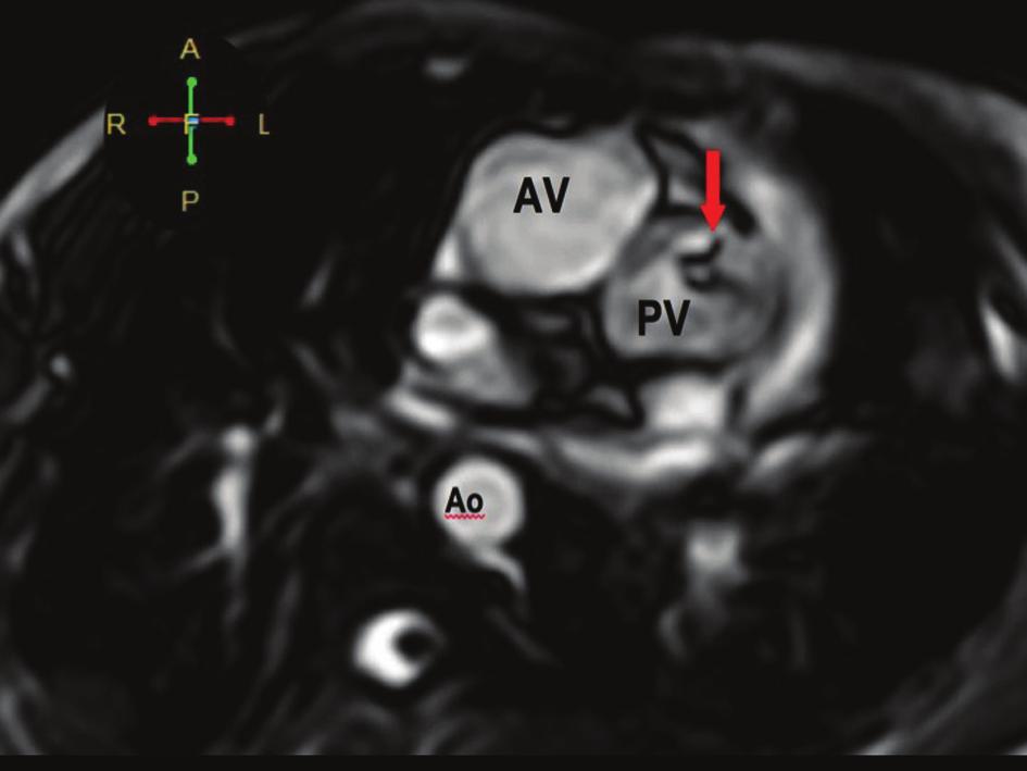 The pulmonary veins drain into the morphologic left atrium located on the right side (atrial situs inversus). pediatrics.