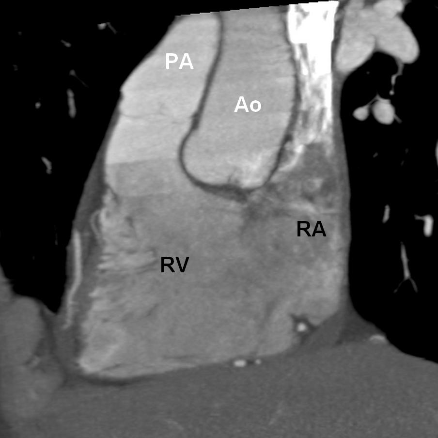 Morphologic Right Ventricle Conus (complete muscular ring) separates AV-valve from arterial valve Moderator Band Septal leaflet closer to
