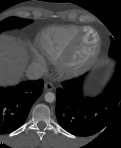 systemic ventricle AV-valve hinge-point more apical