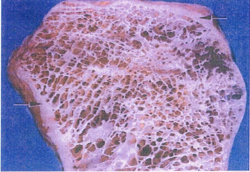 Spongy or cancellous bone bone looks spongy in appearance no complex arrangement for blood vessels fills heads of long bones called marrow always covered by compact bone.