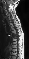 394 M bovis Vertebral Osteomyelitis From BCG Use Mayo Clin Proc, April 2002, Vol 77 Figure 1. Magnetic resonance imaging scan of the lumbar spine.