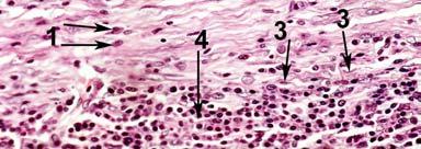 Small arrows show pleural peel and large arrows show thickened visceral pleura.