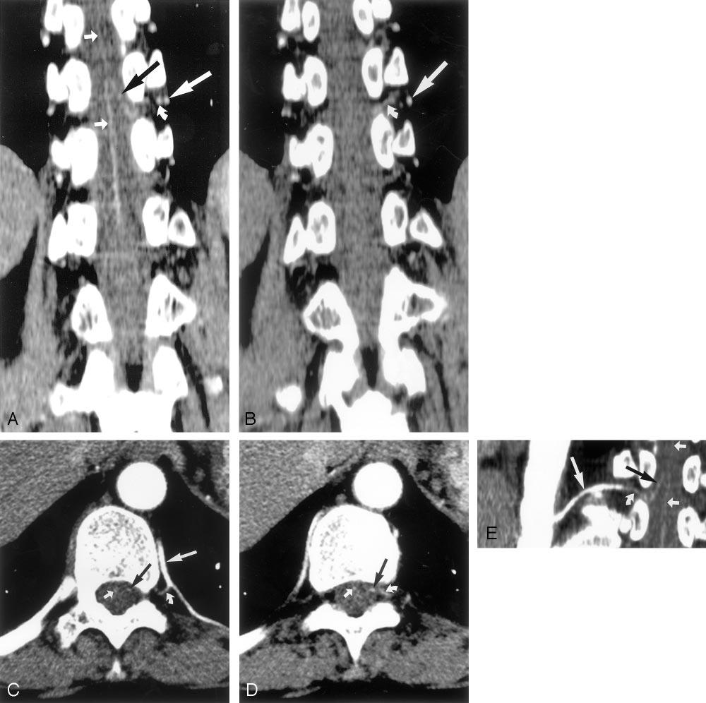 AJNR: 24, January 2003 MULTI-DETECTOR ROW CT 15 FIG 1. CT scans obtained from patient 2, a 52-year-old woman.