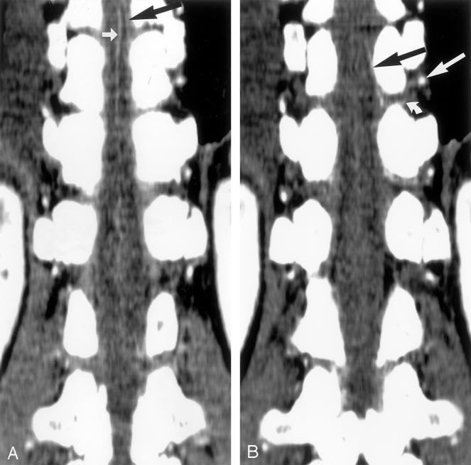 16 KUDO AJNR: 24, January 2003 FIG 2. CT scans obtained in patient 3, a 54-year-old man. A and B, Coronal scans show ASA (small white arrow) and AKA (black arrows).