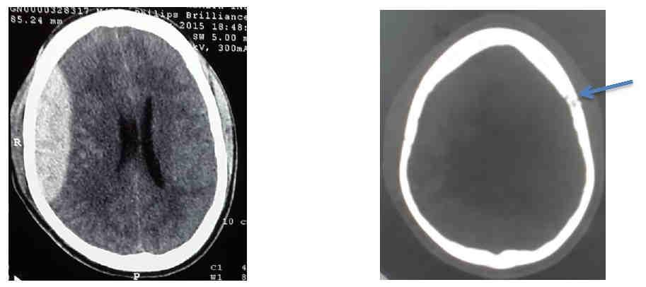 Figure 1 A NCCT head: right fronto-parietal acute extradural hematoma with midline shift towards left.