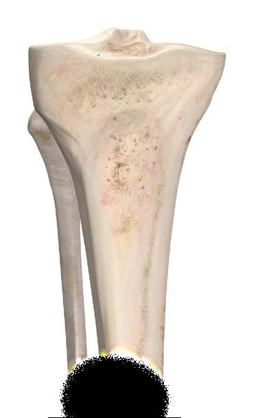 When positioning the guide, apply most of the pressure (~75%) against the anterior aspect of the tibia. It may be