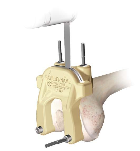 After the femoral alignment/distal resection guide is secured, drill the two distal holes with a 3.25 mm drill bit.