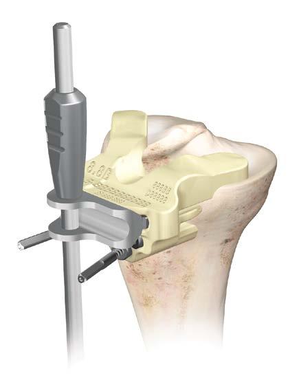 Proximal Tibial Resection (continued) Take the Alignment Verification Adapter (P/N 2000-42-062) (holes need to be oriented laterally) and insert the HP Alignment Rod through the holes.
