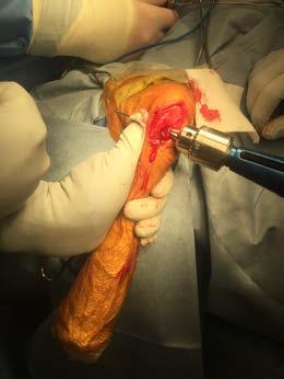 Tibial Tuberosity Hole Pass Suture! Good pass AROUND fabella! Goals:! Entry point:! In valley between fabella and femur!