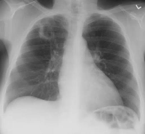TB or not TB Pulmonary