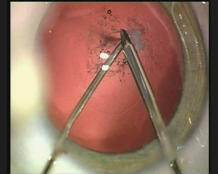 Video 5: anterior persistant foetal vasculature Videoregistration: cataract surgery in children Surgeries: - 46 eyes of 31 children Mean age: - 42 months (range: 1 119 months) - 8 children (11 eyes)