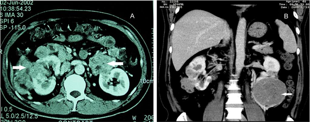 right kidney (arrow). B. The contrast-enhanced computed tomography (CT) of 2009, confirmed the presence of a heterogeneous mass occupying the lower portion of the left kidney (arrow). Figure 2. A.