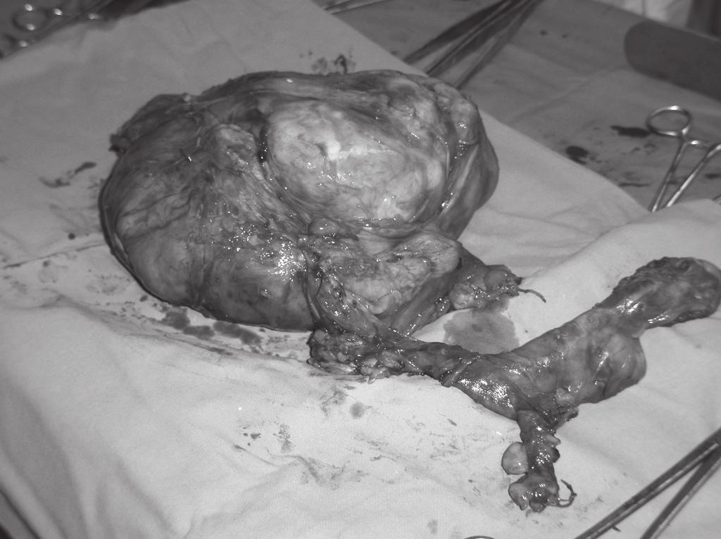 Figure 3 The second part of the excised tumor.