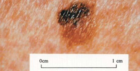 A C E G Figure 1. Photographs of skin lesions included in the questionnaire A. Superficial spreading melanoma B. Seborrheic keratosis C. Lentigo maligna (Hutchinson melanotic freckle) D.