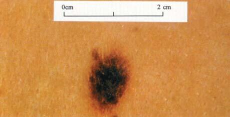 18 21 The results of this study suggest that GPs use their perception of whether the lesion is different to usual moles when making their diagnosis rather than using specific guidelines or checklists.