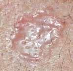 Common Skin Cancers Basal Cell Carcinoma - Superficial - Nodular -