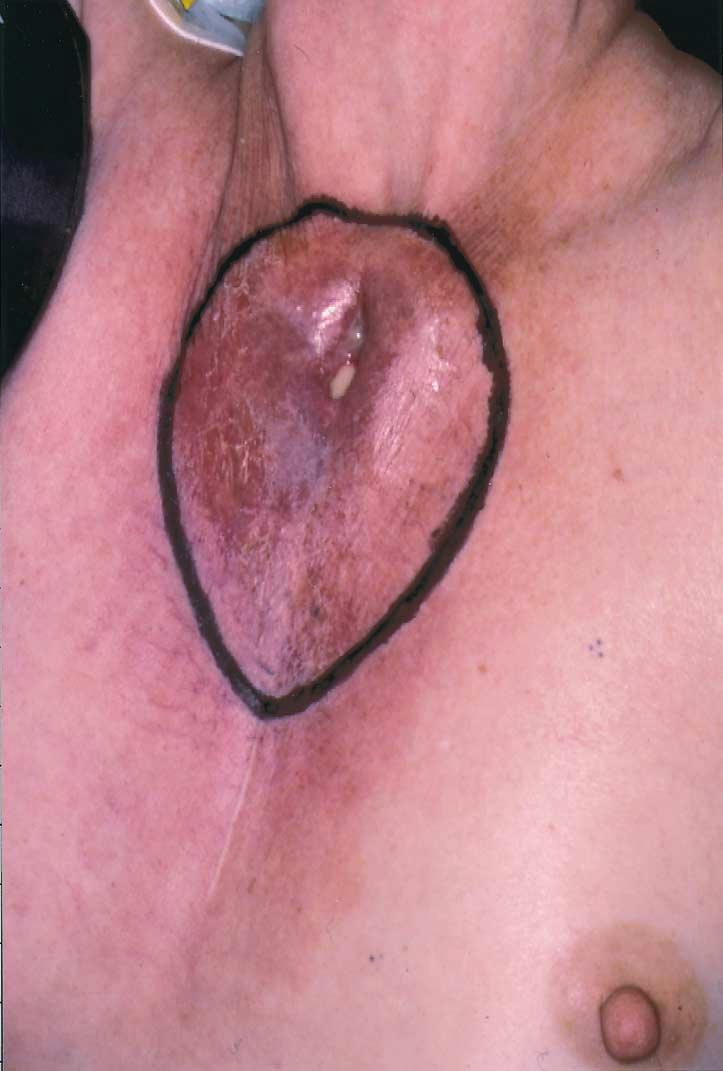 Ann Thorac Surg RAFFOUL ET AL 2001;72:1720 4 RECONSTRUCTION OF INFECTED FULL-THICKNESS CHEST WALL DEFECTS 1721 Fig 1.