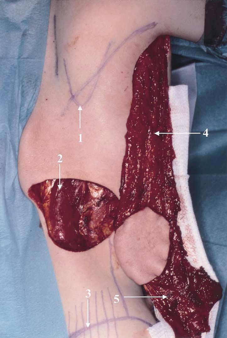 [3]. Fig 2. The harvested flap including the thoracodorsal fascia (patient 2).
