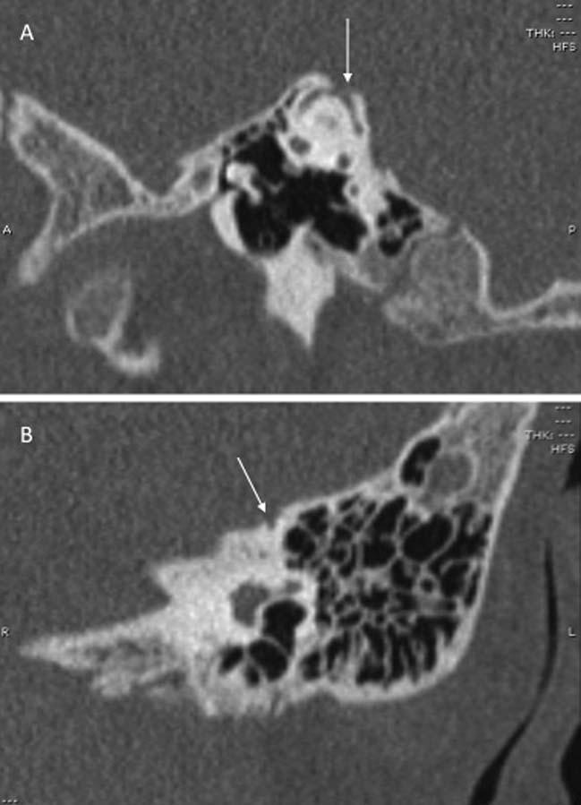 Fig. 2. Computed tomography images of patient 4. Left dehiscent superior semicircular canal in the plane of Poschl (arrow) (A) and coronal view (B).
