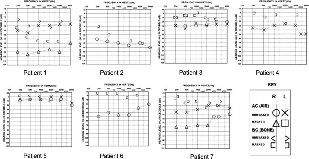 Fig. 4. Audiograms of all seven patients at the time of diagnosis of superior semicircular canal dehiscence. them without a higher index of suspicion.