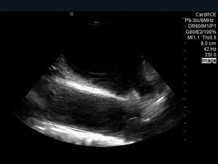 Left Pulmonary Veins From the Left Atrial Appendage