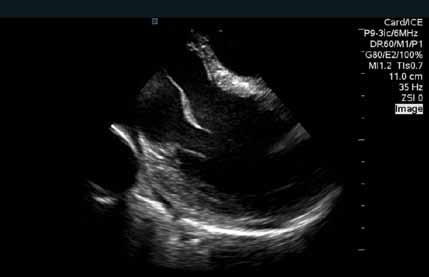 Left Ventricle Long Axis Re-establish Home View Once the tricuspid valve is clearly visible,
