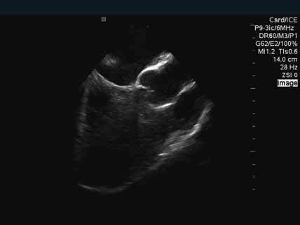 Aorta, Right Ventricular Outflow