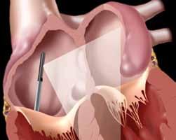 Coronary Sinus Gradually rotate the catheter clockwise