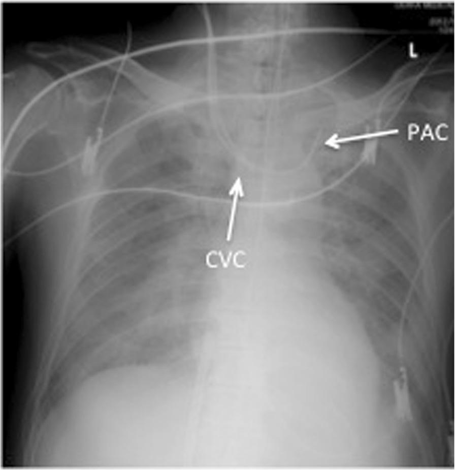 Kusaka et al. JA Clinical Reports (2015) 1:2 Page 2 of 5 Cardiopulmonary bypass (CPB) was established with ascending aortic cannulation and venous drainage from the right atrium.