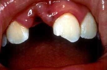 Avulsion With this type of injury, the tooth is completely out of